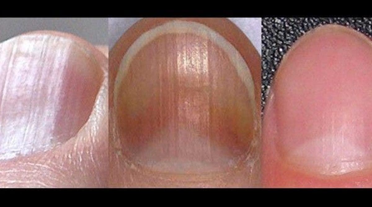8 raisons pour lesquelles vous avez des ongles cassants