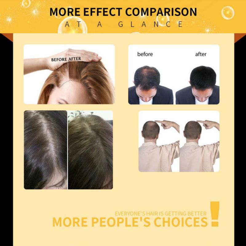 5 excellents et naturels remèdes populaires contre la perte de cheveux