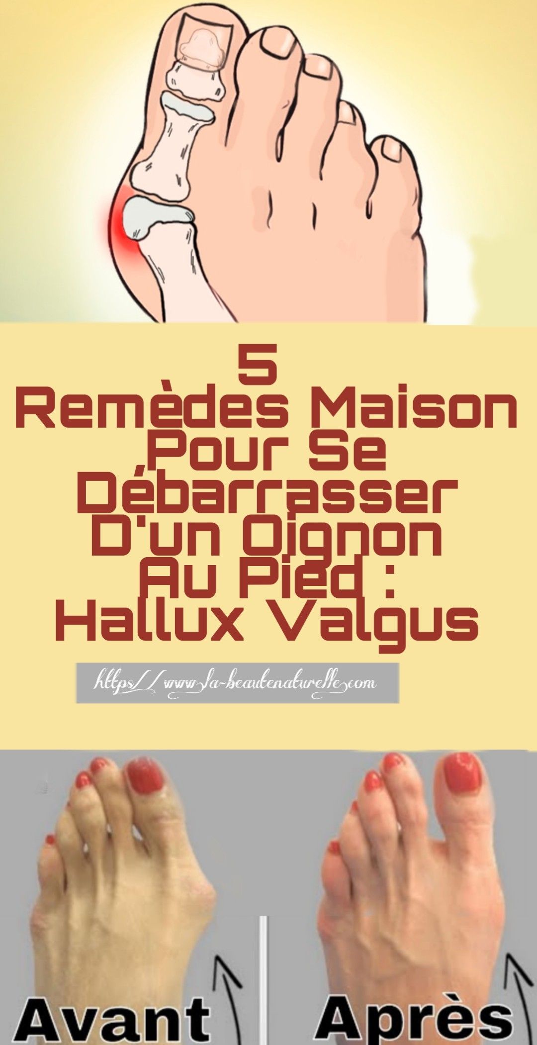 Prévenir hallux valgus avec ces 5 conseils